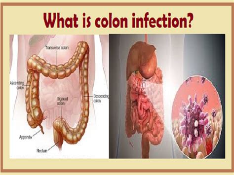 What Is Colon Infection