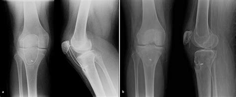 Cureus Neglected Rupture Of The Patellar Tendon After Fixation Of Tibial Tubercle Avulsion In