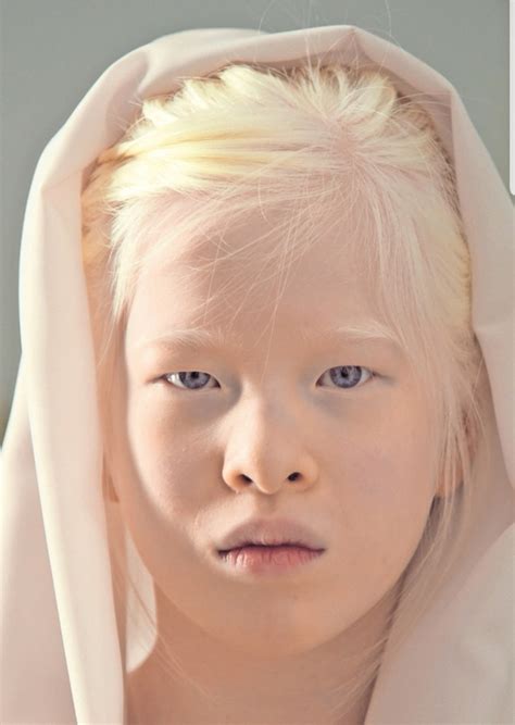 How Much Percentage Of Albinism Do Pale Skinned People Have Quora