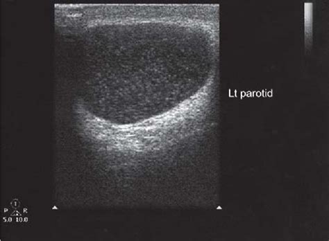 Figure 2 From Lymphoepithelial Cyst Of The Parotid Gland In An Hiv