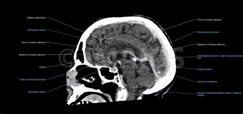 Brain And Face Ct Interactive Anatomy Atlas E Anatomy
