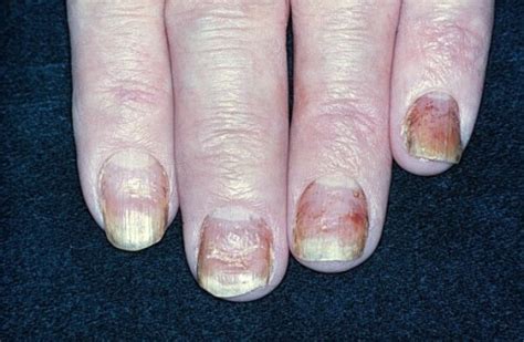 Dermatitis Of The Nails In A Patient With Atopy Open I