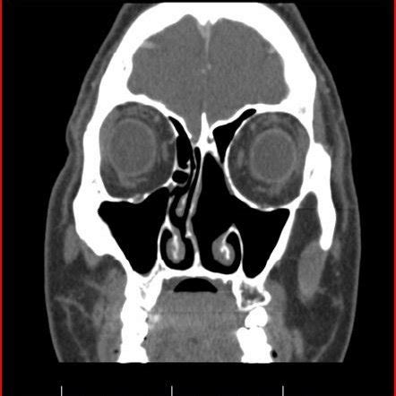 Nasal Cavity And Paranasal Sinus Cancers Paranasal Sinuses Nasal My