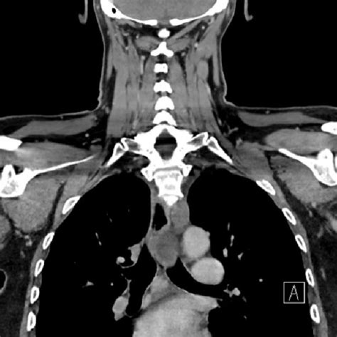 Axial Ct Image Showing The Thoracic Duct Cyst Download Scientific