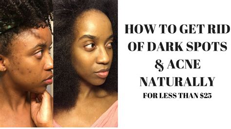 How To Get Rid Of Acne And Dark Spots Naturally Holistic Skincare