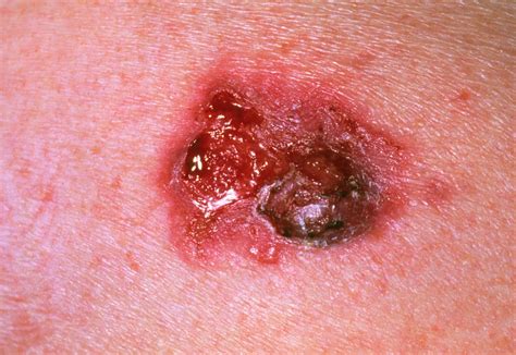 Skin Cancer Photograph By Dr P Marazziscience Photo Library