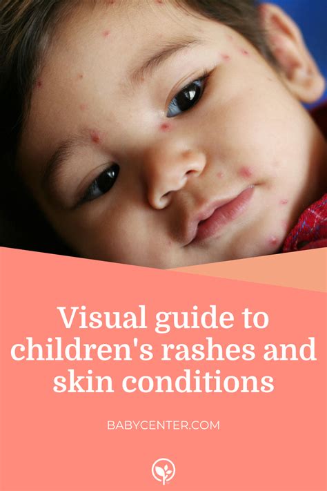 Visual Guide To Childrens Rashes And Skin Conditions Babycenter In
