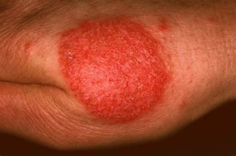 Pityriasis Rosea Differential Diagnosis Wikidoc