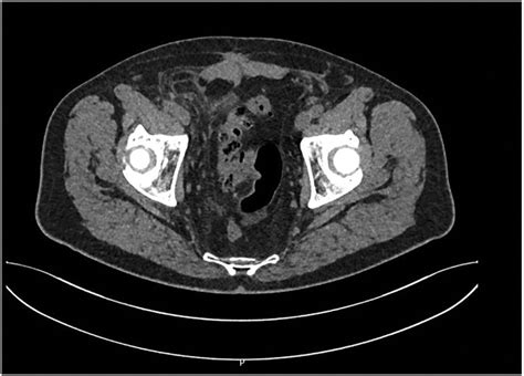 Acute Sigmoid Diverticulitis Caused By Incarceration Of A Right