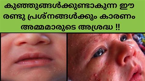 Causes And Home Remedies To Treat Baby Acne And Miliaകുഞ്ഞുങ്ങ