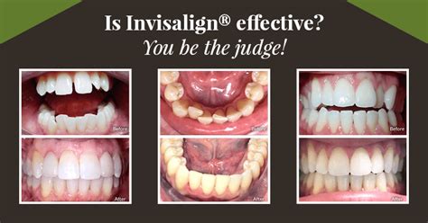 How long does it take to remove braces? How Long Does Invisalign® Take? | Discovery Dental
