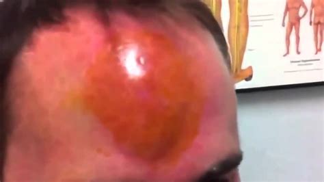 Giant Pimple On Forehead Youtube