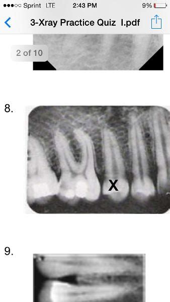 Dental Assisting X Ray Quiz 1 Flashcards Easy Notecards