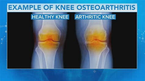 Sports Medicine Doctor On How To Combat Knee Arthritis Symptoms Cbs News