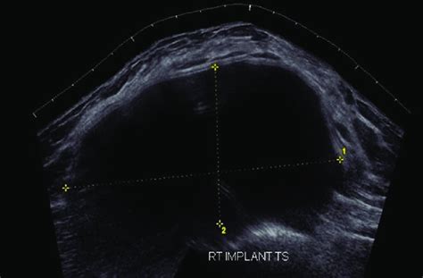 Transverse Ultrasound Image Of A Woman With Capsular Contracture Of