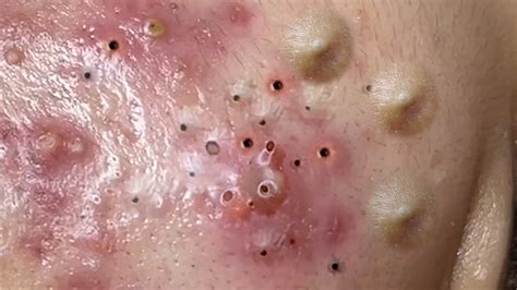 Relax Everyday With Spa Popping Huge Blackheads And Pimple Popping