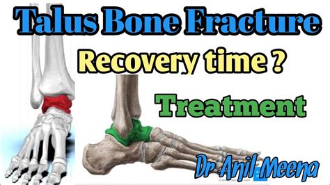 Femur Bone Fracture Recovery Time In Hindi Femur Fracture My Xxx Hot Girl