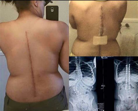 Before And After X Rays Of My Spinal Fusion Surgery 6 Weeks After 😆