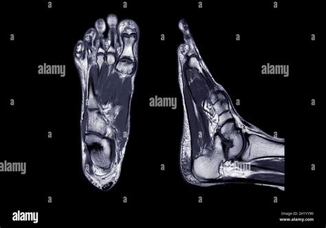 Manetic Resonance Imaging Of Foot Or Mri Foot Pdw Axial Coronal And