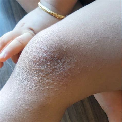 Asktheexpert My Child Is Girl And 5 Yrs Old She Is Having Rashes At