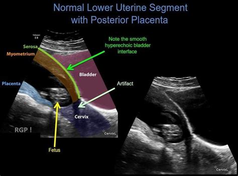 Pin By Tubidymobilevideo On Gynecology Diagnostic Medical Sonography