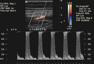 Ultrasound Assessment Of Lower Extremity Arteries Radiology Key