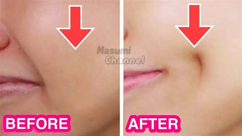 How To Get Dimples Fast And Naturally Simple Facial Exercises To Get Dimples Without Surgery