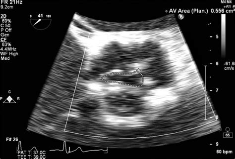 Planimetry Of A Stenotic Aortic Valve Area In The Me Av Sax View The