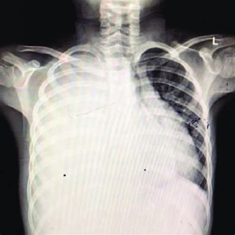 Chest X Ray Showed Massive Pleural Effusion In The Right Thorax
