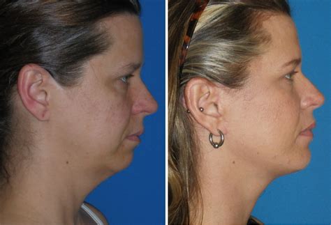 Chin Implants The Fastest Growing Cosmetic Surgery Procedure