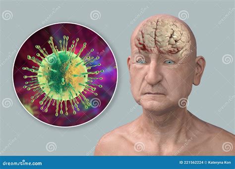 Infectious Etiology Of Dementia Viruses That Affect Neurons Royalty