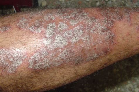 Plaque Psoriasis On Legs Photos Symptoms And Pictures