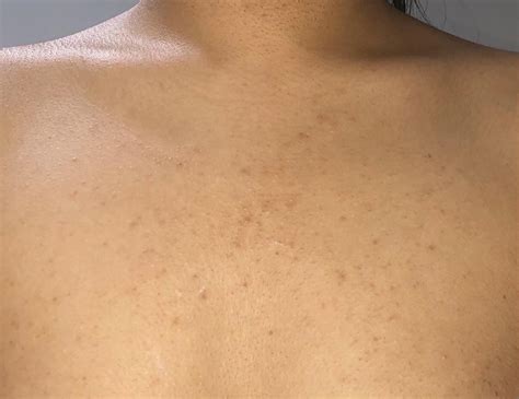 Is This Fungal Acne Ive Had These Bumps On My Chest For Quite Some