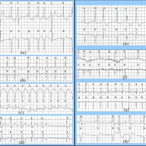 Examples Of Different Cardiac Arrhythmias With Correct A D And