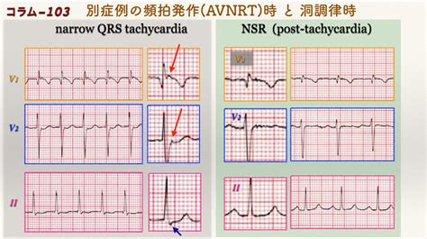 【コラム 103 Ecg Guruより Supraventricular Tachycardia In Pediatric Patient