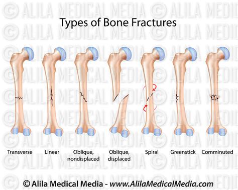 Alila Medical Media Types Of Bone Fractures Medical Illustration