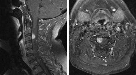 Extramedullary Spinal Cord Tumor The Neurosurgical Atlas By Aaron