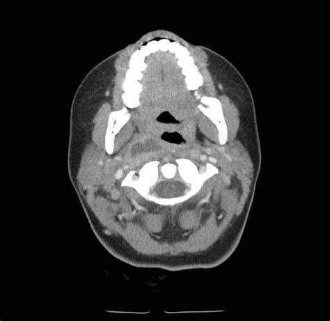 Parapharyngeal Space Abscess