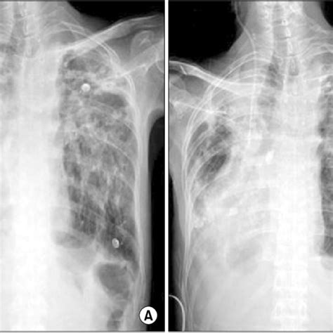 Preoperative A And Postoperative B Chest Radiographs Download