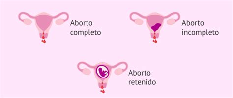 Tipos De Abortos Espont Neos Seg N La Variedad Cl Nica