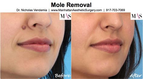 Did You Know That Facial Moles Can Be Removed With Almost No Visible