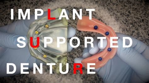 Implant Supported Denture Youtube