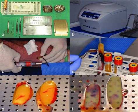 Choukroun macht es möglich, mit körpereigenem blut eine membran (oder suspension) herzustellen, welche dank patienteneigenen. Preparation of L-PRF membrane from the patient's own blood ...
