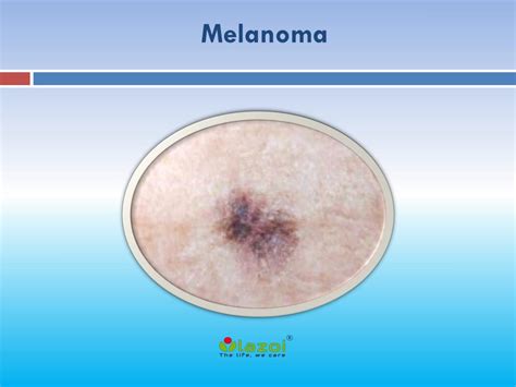 Ppt Melanoma Causes Symptoms Daignosis Prevention And Treatment
