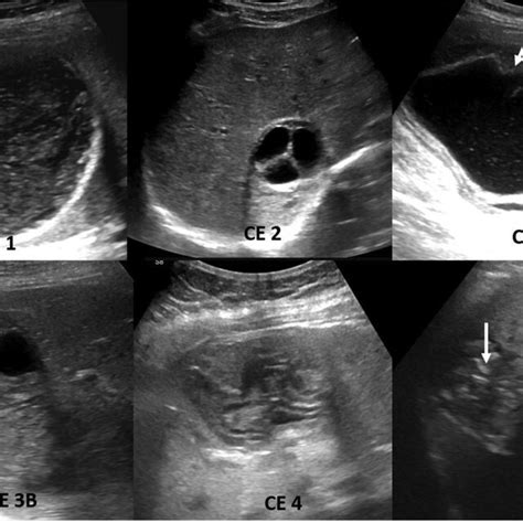 Hydatid Cyst Ultrasound Multiple Stages Of Hydatid Cyst Are Shown