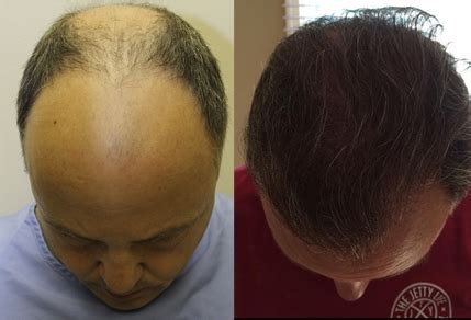 Hair Transplant Results Toronto Hair Transplant Surgeons