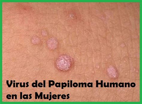 Virus Del Papiloma Humano En Las Mujeres Que Consecuencias Existen My Xxx Hot Girl