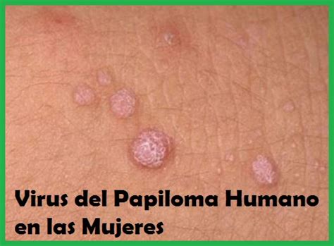 Virus Del Papiloma Humano En Las Mujeres Que Consecuencias Existen My XXX Hot Girl