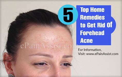 5 Top Home Remedies To Get Rid Of Forehead Acne