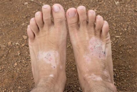 Here Are The Top Most Common Fungal Infections Professional Surgical